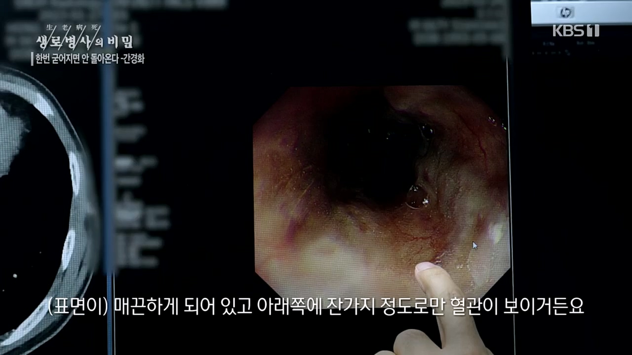 생로병사의 비밀.E863.230406p.H264-F1RST.mp4_20230406_202715.653.jpg