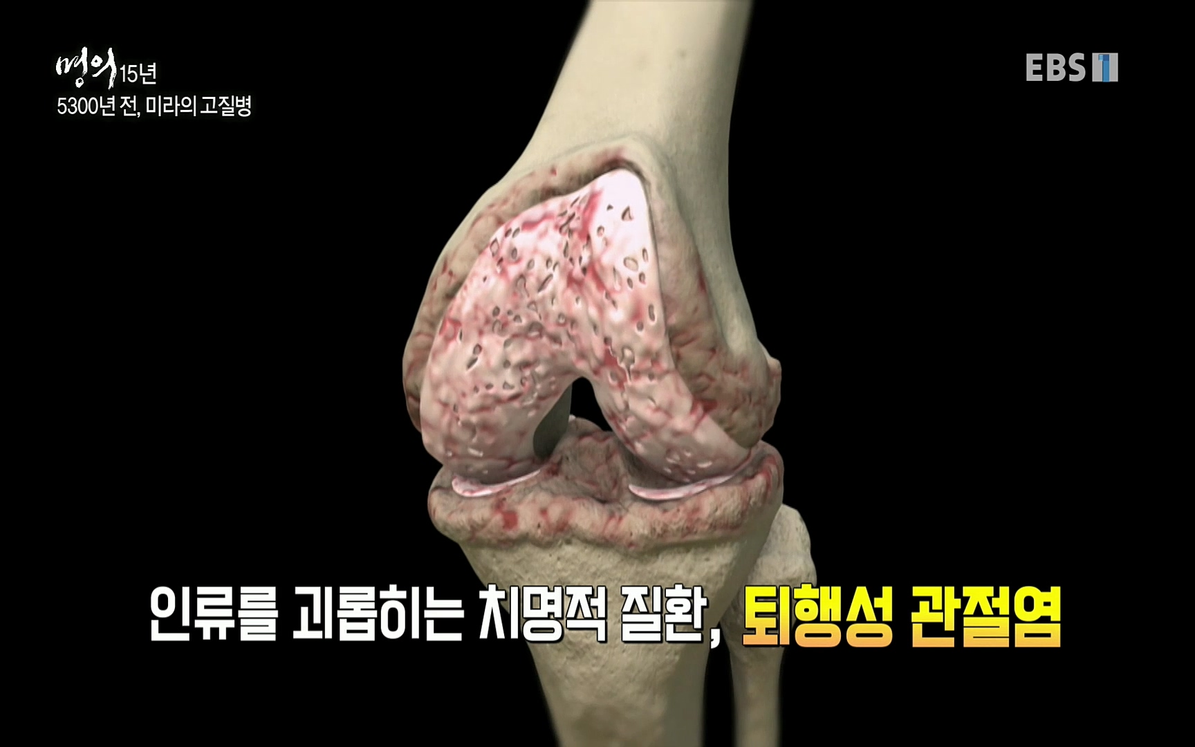 EBS 명의 헬스케어 - TV - 교육의 중심 EBS명의 15년 - 퇴행성관절염, 다시 걷는 사람들.mp4_20220803_205347.933.jpg