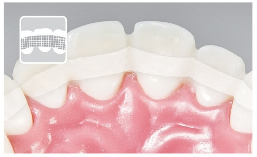 흔들리는 치아 치료법 - 스플린트 요법