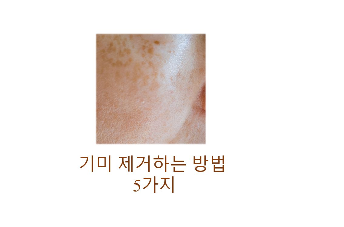 광대뼈 부근에 기미가 낀 피부