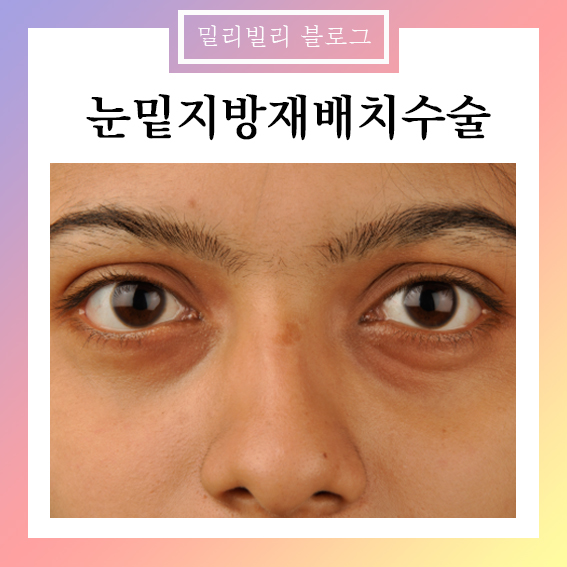 서면 눈 밑 지방 제거? 피부과 전문의가 추천할 수 없는 이유