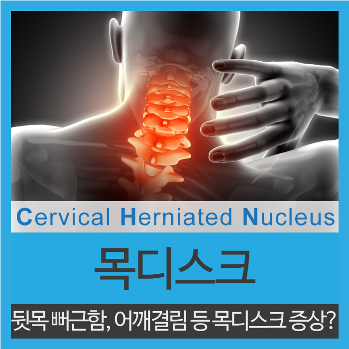 목디스크 증상 원인을 제거하면 됩니다.