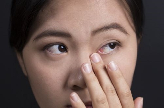 눈곱이 끈적거리면서 유독 누렇다면 세균성 결막염이나 각막염이 원인일 수 있다.