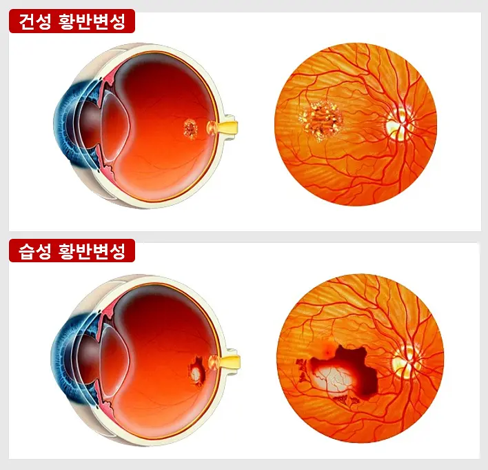 황반 변성 (Macular Degeneration)