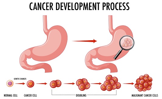 stomach-cancer