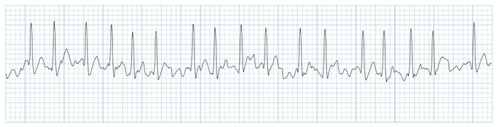 atrial fibrillation 심방세동