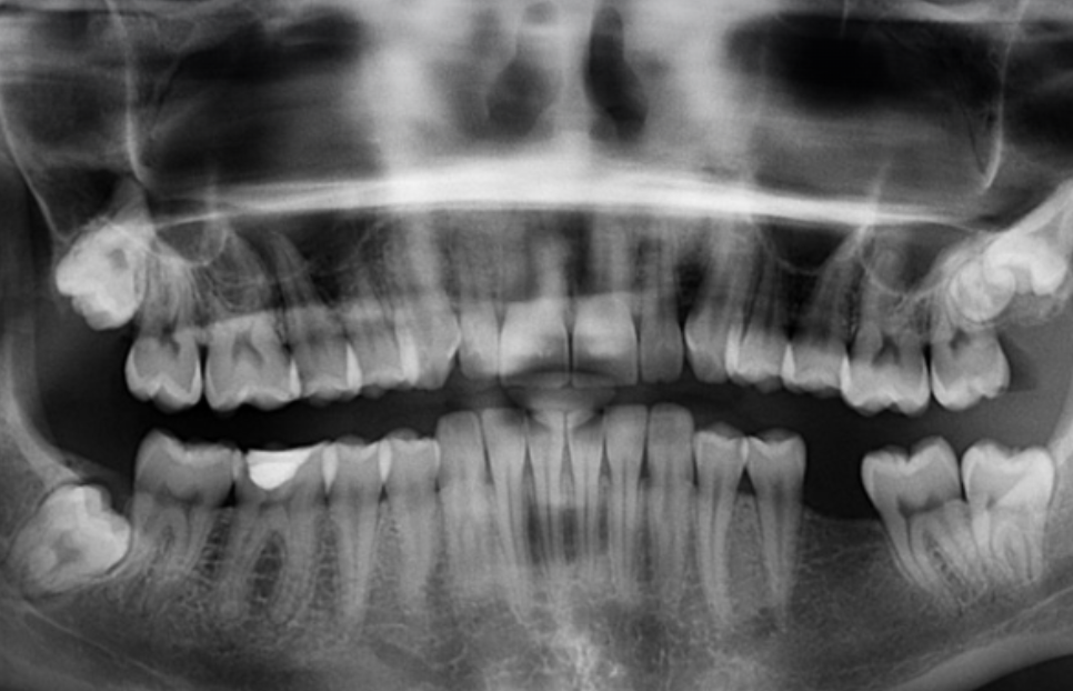 사랑니 치아 발치 _ 치아 이미지 엑스레이