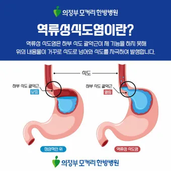 역류성 식도염 원인 초기증상 예방하는 방법_2