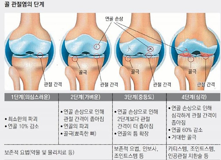 골 관절염의 단계별 진행과정