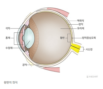  망막전막 원인 및 증상 수술 치료 - 자가진단 방법