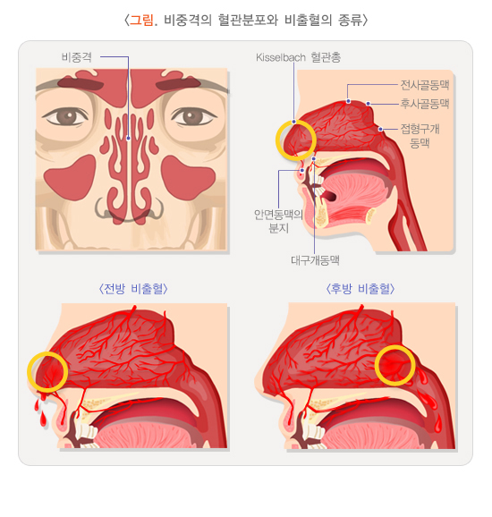 비중격의_혈관분포와_비출혈의 종류