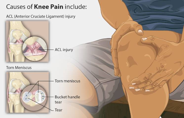 무릎 앞쪽 통증 회복 운동의 이점