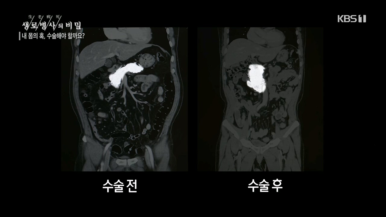 생로병사의 비밀.E870.230532p.H264-F1RST.mp4_20230605_201525.820.jpg