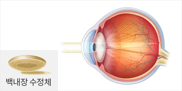 백내장 증상