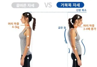 거북목 증상 치료법 스트레칭_34