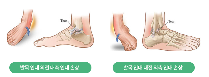 발목 불안정성
발목 인대 외전 내측 인대 손상