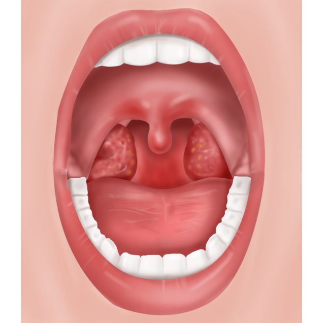 편도선염 증상