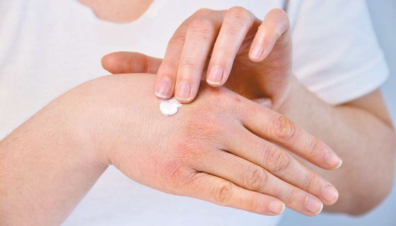 환절기 피부 질환(습진&amp;#44; 건선 등) 예방 및 치료법