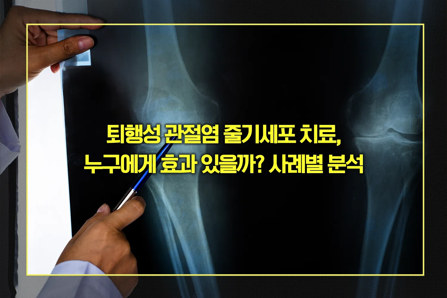 퇴행성 관절염 줄기세포 치료 효과