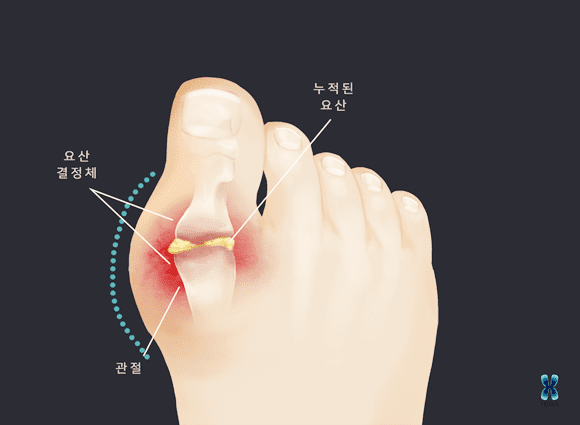 통풍-이유-설명