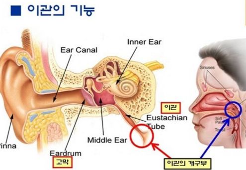 이관개방증 증상