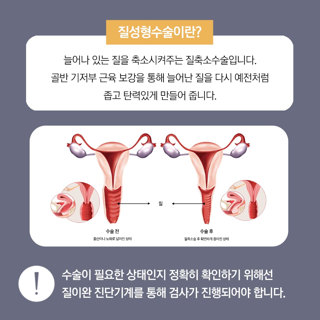 모란산부인과 질수축
질성형수술이란