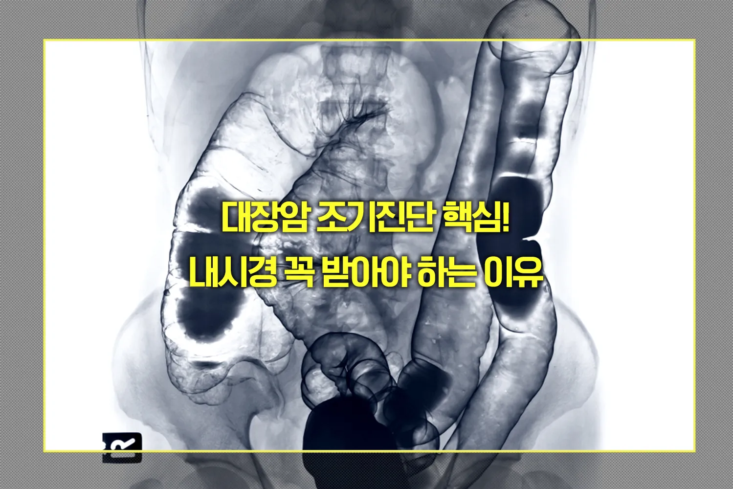 대장암 내시경 받아야 하는 이유