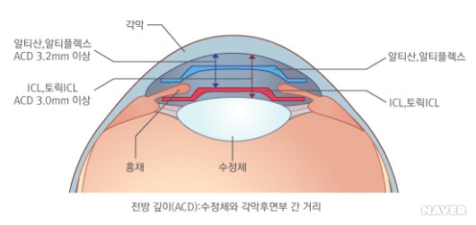  [질병] 노안교정 수술 후기 (1)_수술전 과정