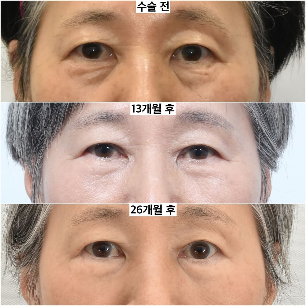 하안검후기