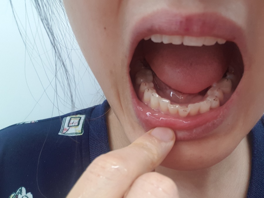 스플린트점검&#44; 치아에 묻은 교압지 흔적