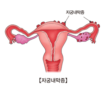 자궁내막증(출처:서울아산병원)