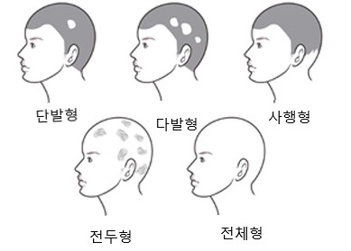  원형 탈모증의 원인은 스트레스이며 원형탈모증 예방 및 대책