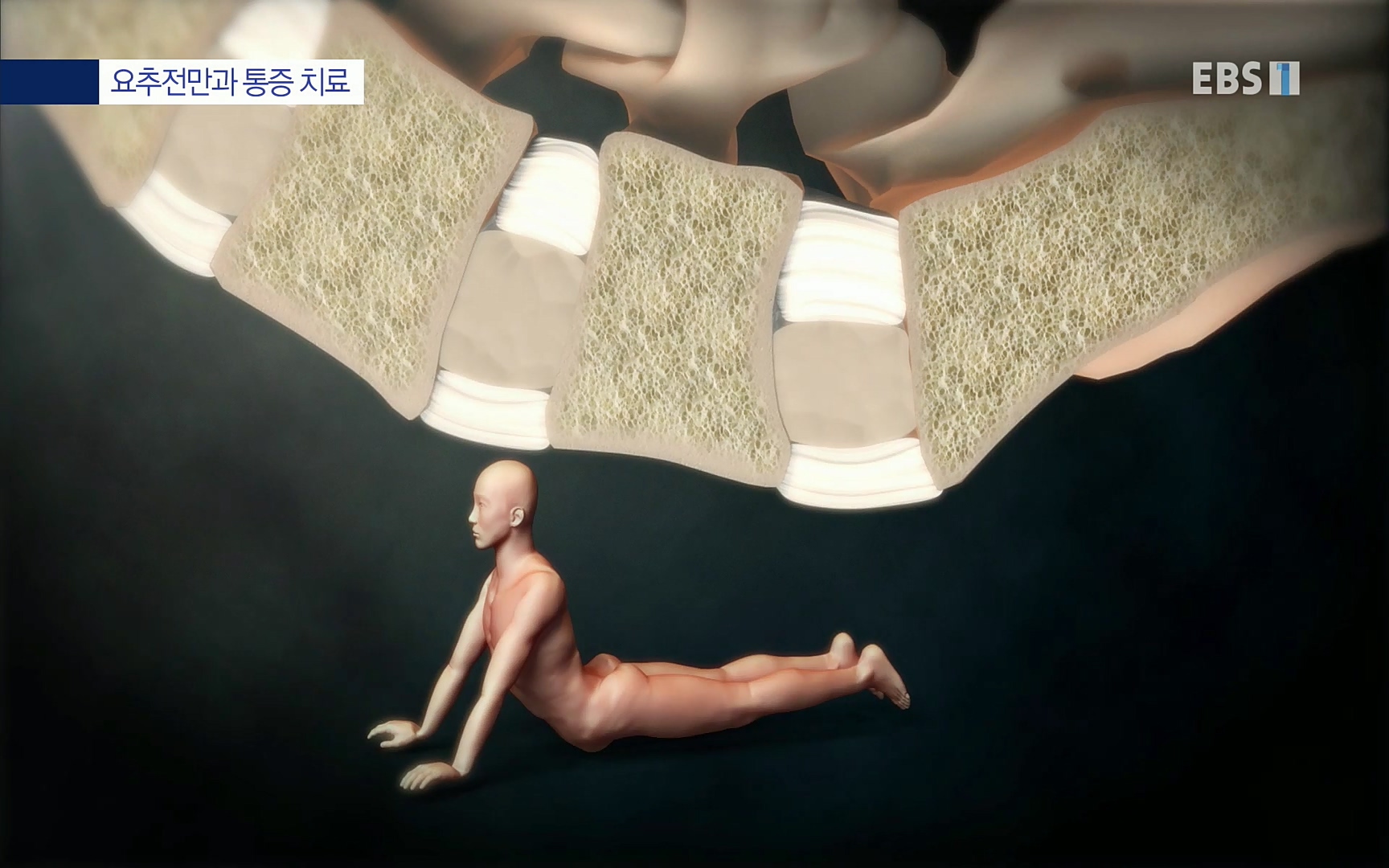 EBS 명의 헬스케어 - TV - 교육의 중심 EBS허리 통증 치료 프로젝트 1부, 수술없이 낫는다 .mp4_20220712_204017.609.jpg
