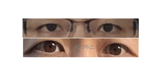 렌즈삽입술 전후사진