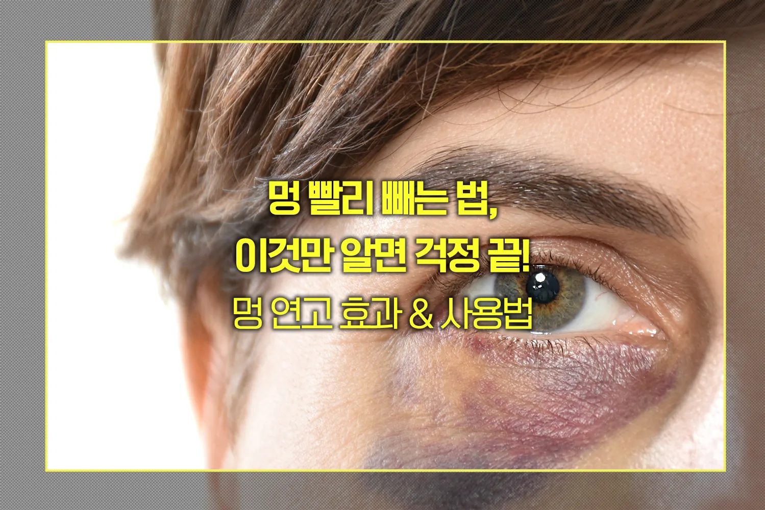 멍 빨리 빼는 연고 효과