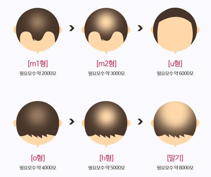 탈모-유형-모발이식-개수-설명-사진