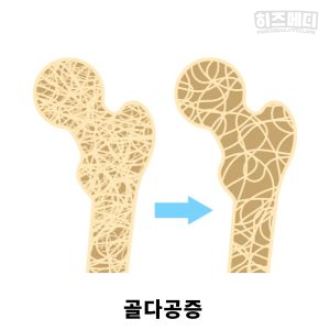 비타민D 부족증상