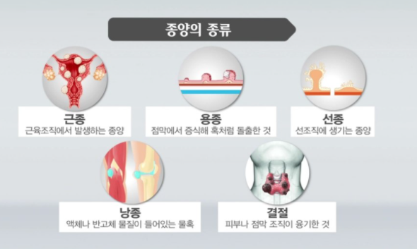  근종, 선종, 용종, 낭종’의 차이