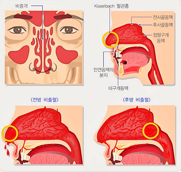 전방 코피(비출혈), 후방 코피(비출혈)