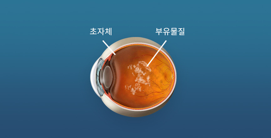 비문증 증상