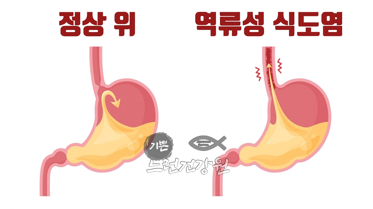 정상 위의 모습과 역류성 식도염이 생긴 위