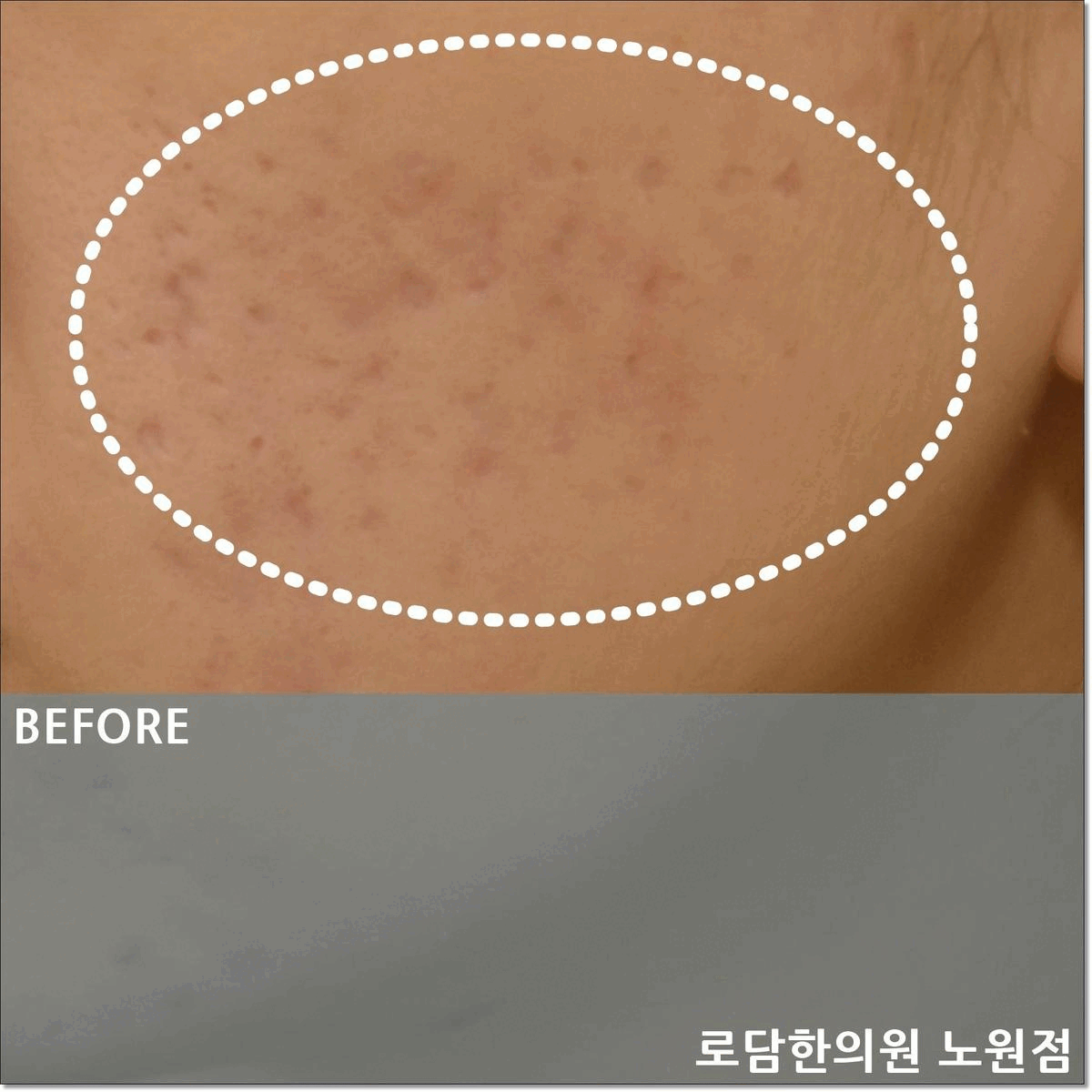  의정부 여드름 흉터 파인 자국 제거 치료 과정 새살침