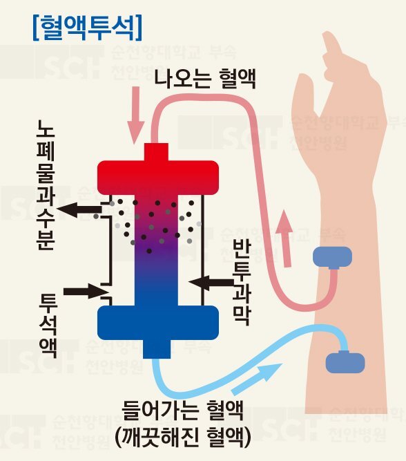 만성 신부전(2) 치료 - 투석