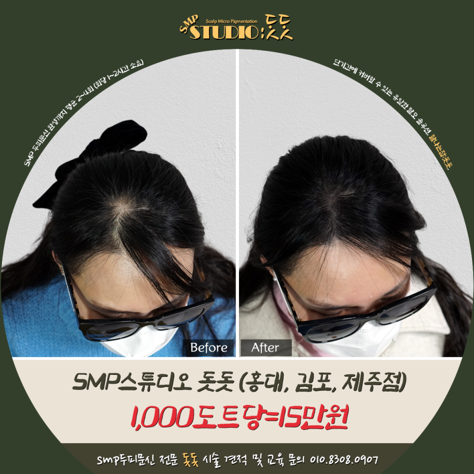  여자 앞머리 탈모 smp 두피문신 받은 이야기
