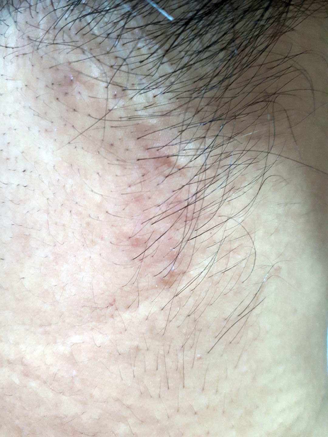  대상포진 목 뒤 부위 : 화이자 연관성, 전염성, 증상, 치료 후기.
