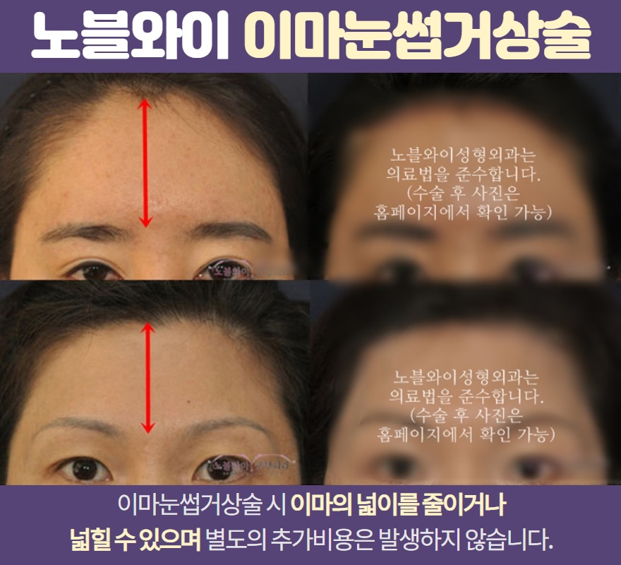 이마눈썹거상술 진행 과정 알아보기 3