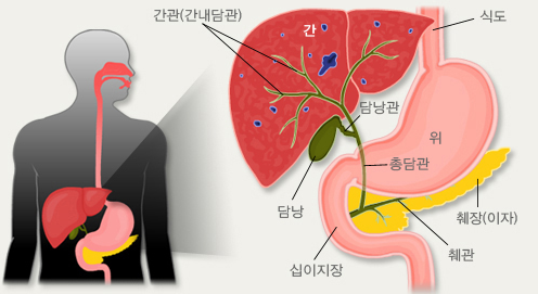 담낭암 이미지