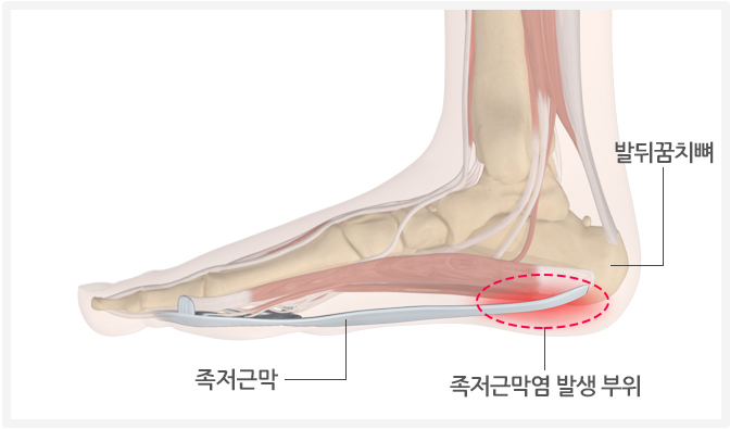 족저근막염