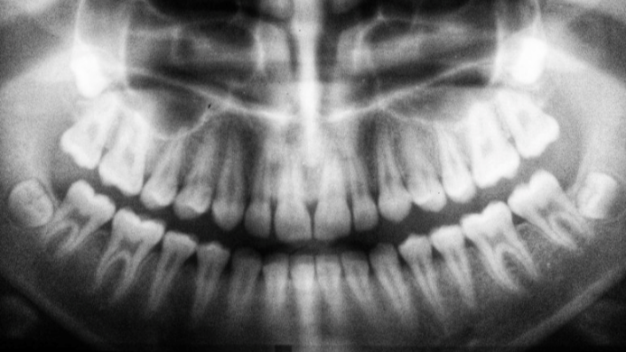 치아성형부작용