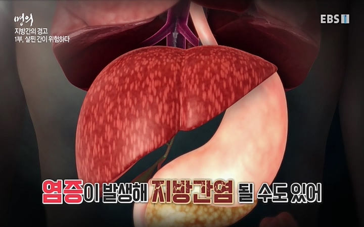 명의_ 제 764회 〈지방간의 경고 1부, 살찐 간이 위험하다〉_ 220429.avi_20220503_193628.245.jpg